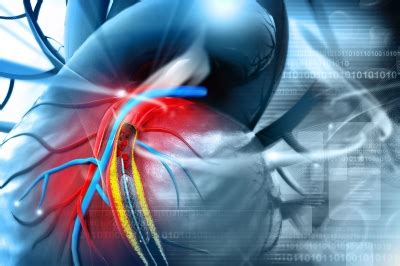 Stent Procedure to Treat Coronary Heart Disease