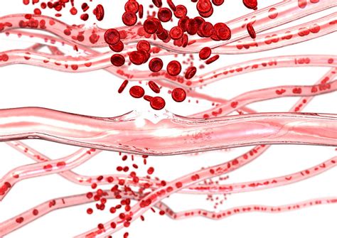 Ruptured blood vessels – Bild kaufen – 11868760 Science Photo Library