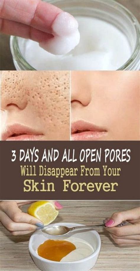 ALL OPEN PORES WILL DISAPPEAR FROM YOUR SKIN FOREVER IN JUST 3 DAYS! | Skin treatments, Face ...