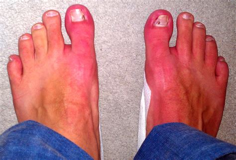 Erythromelalgia in Toes Info (Not CRPS Complex Regional Pain Syndrome)