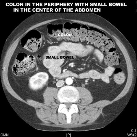 Bowel obstruction / Ileus