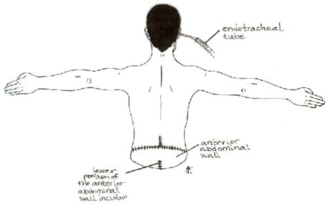 An Improved Hemicorporectomy Technique | Semantic Scholar