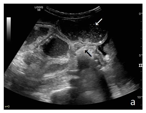 Diagnostics | Free Full-Text | Ultrasound of Small Bowel Obstruction: A Pictorial Review