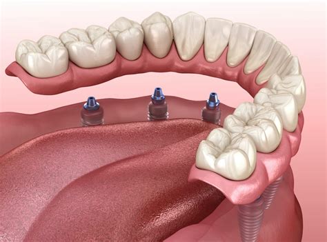 What are Fixed Hybrid Dentures? | Arlington Heights, IL Dentist