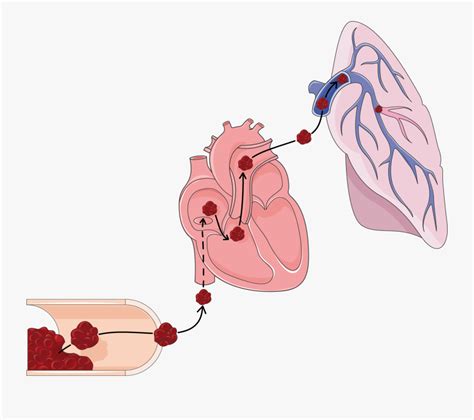 Pulmonary Embolism Clip Art , Free Transparent Clipart - ClipartKey