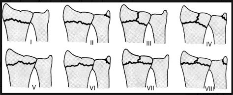 11:50: Clasificación de Frykman para fracturas del extremo distal del radio