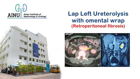 Lap Left Ureterolysis with Omental Wrap (Retroperitoneal fibrosis) | Surgical Videos - YouTube