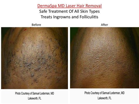 laser hair removal dallas for dark skin - Brain Yost