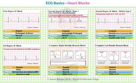 ECG Basics - Heart Blocks #Diagnosis #Cardiology #MedStudent ... | GrepMed