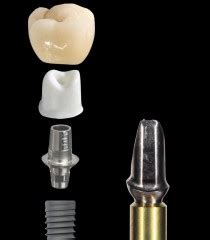 The 2-Piece Custom Implant Abutment - Spear Education