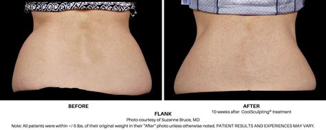 Does CoolSculpting Really Work? CoolSculpting Reviews