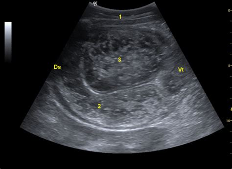 Ultrasonogram of the enlarged pylorus. Ultrasonogram of the enlarged... | Download Scientific ...