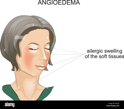 vector illustration of angioedema. allergic swelling of the soft ...