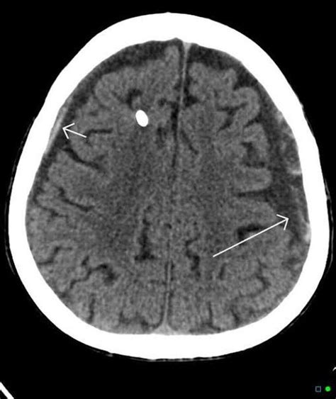 Chronic subdural hematoma - MEDizzy