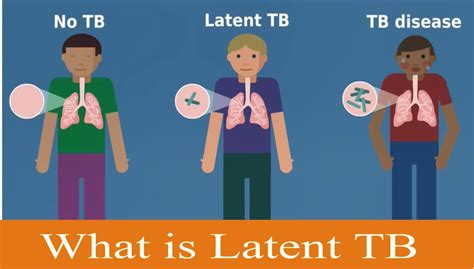 लेटेन्ट (Latent TB) क्या है कैसे पता चले की आप गुप्त टीबी के रोगी है ...