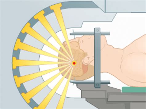 Stereotactic radiotherapy and stereotactic radiosurgery for brain ...