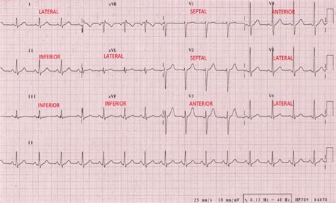 Ischemia Injury Infarction EKG Interpretation | EKG.Academy