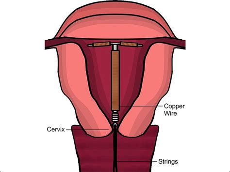 EURAS-IUD: Risk for Uterine Perforation Low