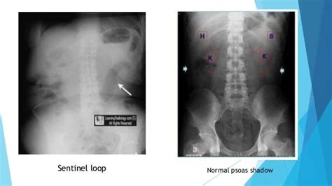 Sentinel Loop Sign In Pancreatitis - A sentinel loop is a sign seen on ...