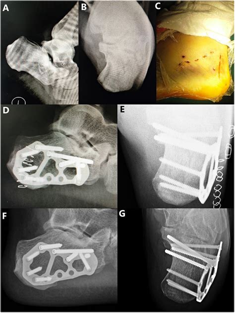 A 31-year-old male patient who fell from a height, resulting in a ...