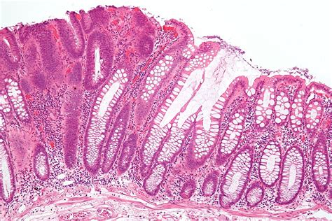 Difference Between Adenoma and Carcinoma | Definition, Types, Causes, Symptoms, Diagnosis, Prognosis