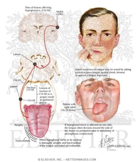 Hypoglossal Nerve (CN-XII)