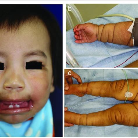 (PDF) General anesthesia of a Japanese infant with Barber-Say syndrome: a case report