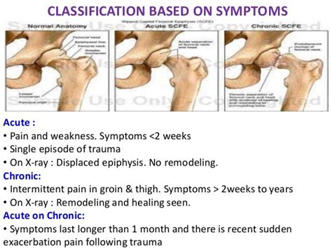 Slipped Upper Femoral Epiphysis (SUFE)