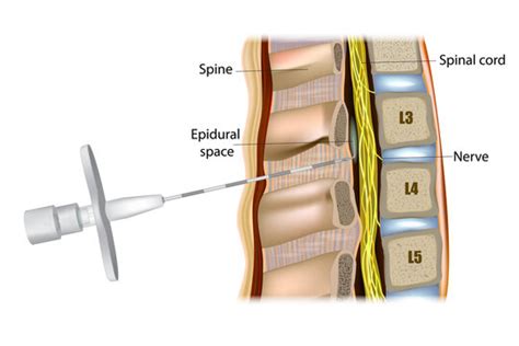 EpiGlide® Tuohy Epidural Needles – Welcome to Busse Hospital Disposables