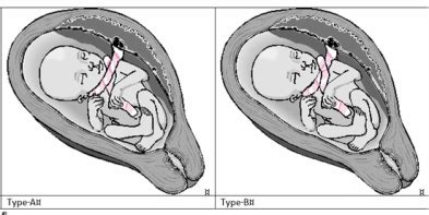 Is cord around the neck (nuchal cord) a problem or not? - Stellar Research