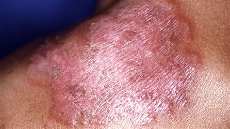 Skin Problems Image Gallery | HowStuffWorks