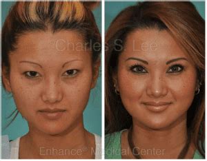 Asian Eyelid Surgery Can Give You the Look You Want | Charles S. Lee, MD