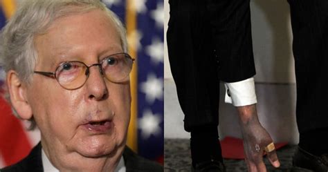 Mitch McConnell’s mysteriously bruised hands spark health questions - National | Globalnews.ca