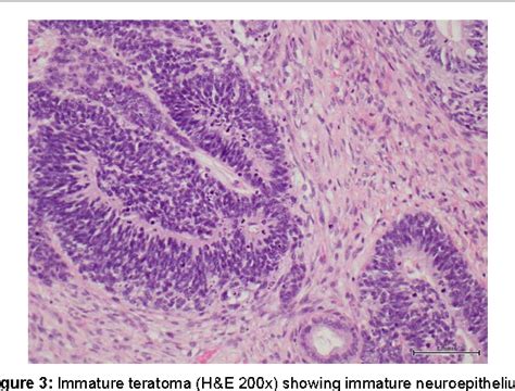 Teratoma Histology