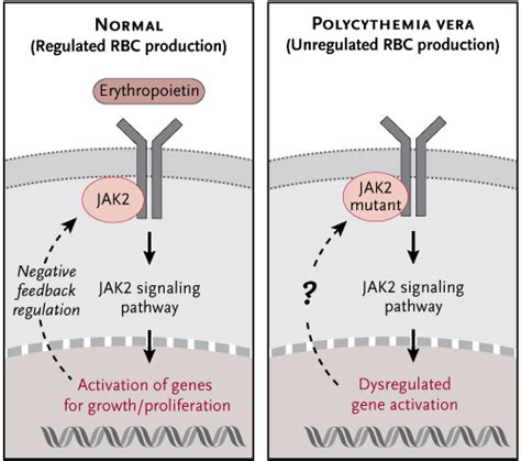 Polycythemia Vera - Stepwards