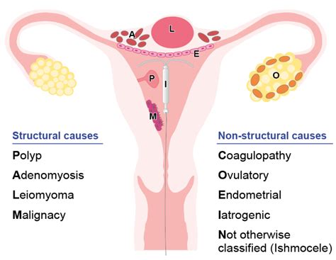 Dysfunctional Uterine Bleeding – Best Ayurveda