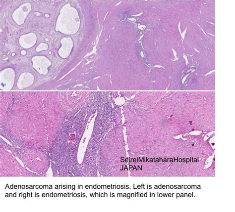 Pathology Outlines - Adenomyosis / adenomyoma