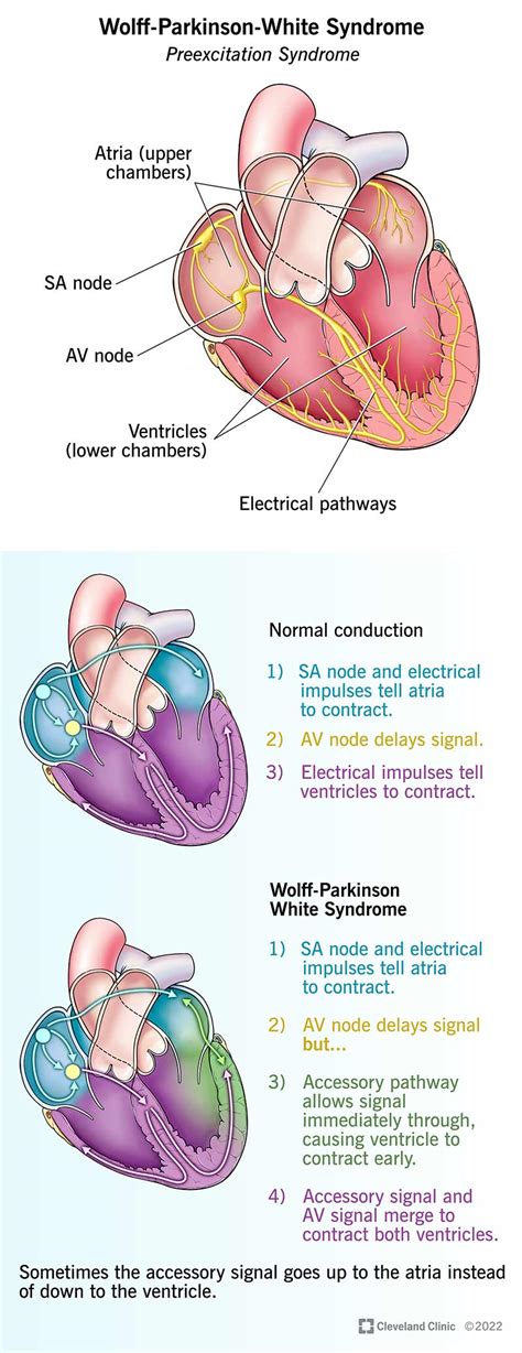 Bundle Of Kent Anatomy