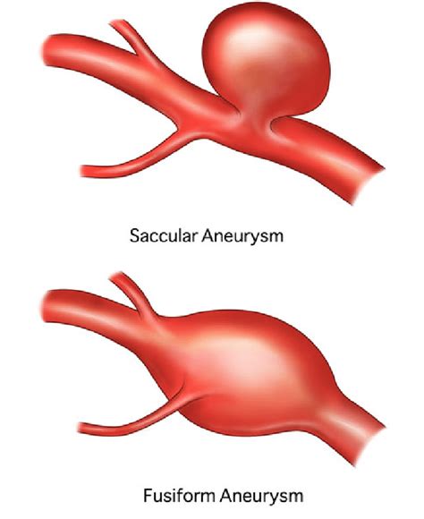 Abdominal Aortic Aneurysm Treatment