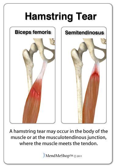 The biceps femoris muscle is the most frequently injured, as it suffers the largest stretch ...