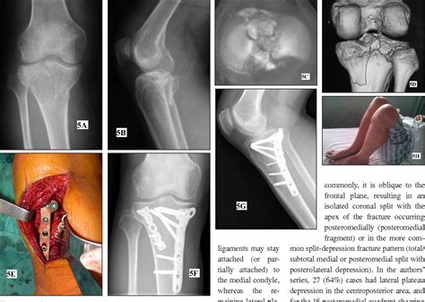 Medial Tibial Plateau Fracture Treatment