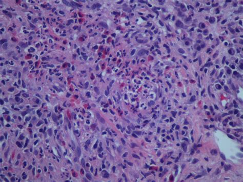 Granuloma faciale: Case report and review