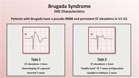 Cardiology MCQ 53: Brugada syndrome