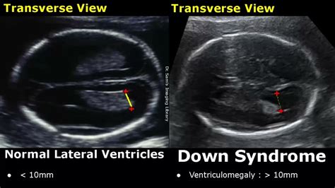 Fetal Ultrasound Normal Vs Down Syndrome | Soft Markers In Fetus For Trisomy 21 | Aneuploidies ...