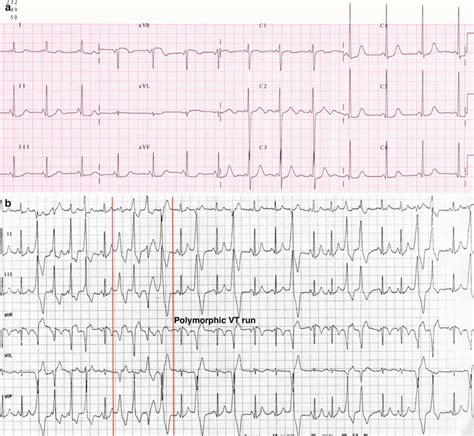 Channelopathies | Thoracic Key