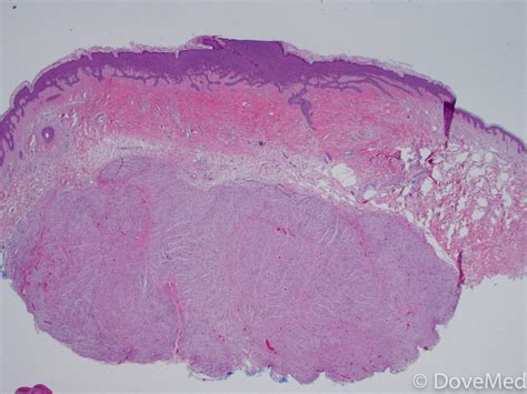 Neurofibroma of Skin