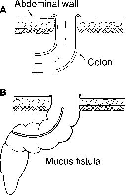 Ileostomy And Mucous Fistula