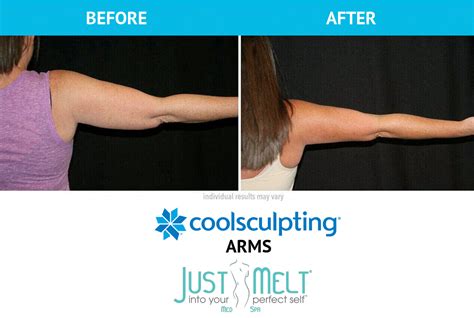 CoolSculpting for Arms in NYC - Just Melt Med Spa