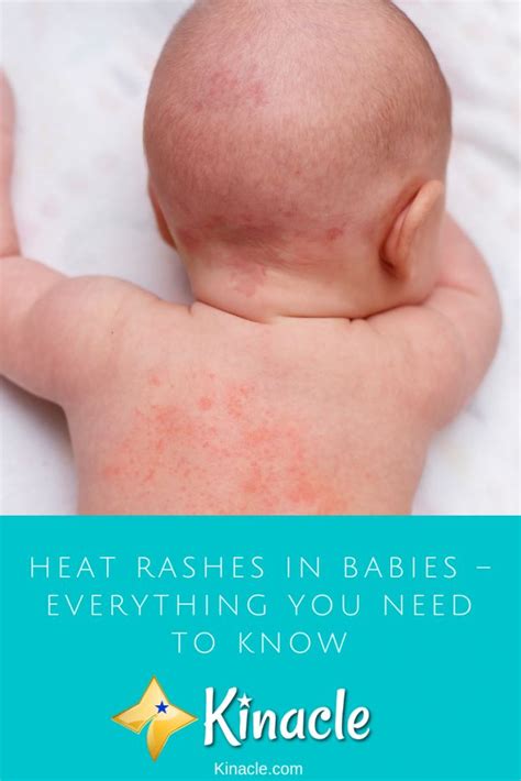 Heat Rashes In Babies – Everything You Need To Know | Heat rash, Baby rash, Heat rash remedy