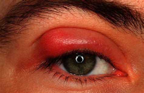 Pink Eye (conjunctivitis) - Symptoms and Treatment | Page 4 | Things Health